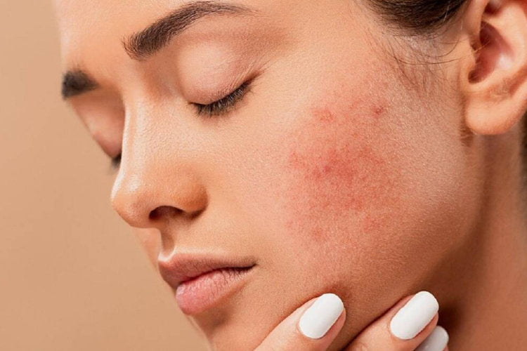 Prevenga los brotes de dermatitis atópica en seis pasos